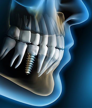 Keramički ili titanski zubni implantati