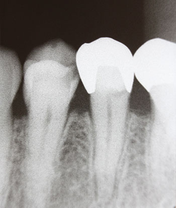 Rendgensko snimanje zubi za nekoliko minuta